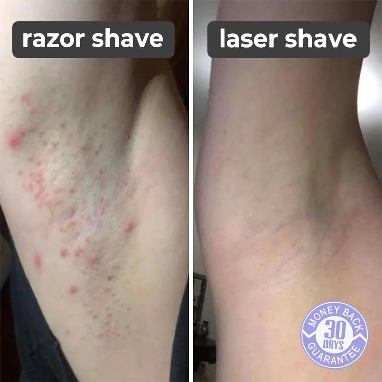 LAST DAY OF DISCOUNT 🔥 SMARTEK® LASER SHAVER